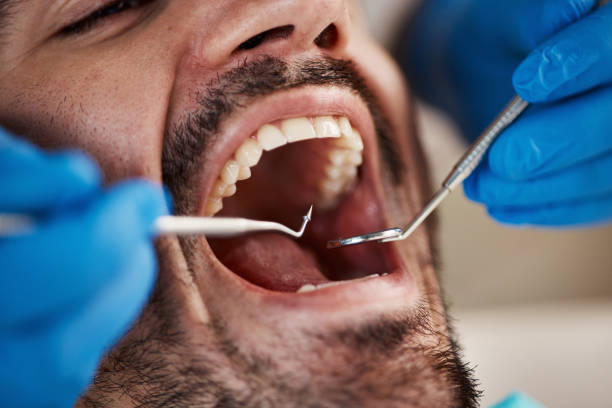 Best Emergency Dentist for Lost Fillings or Crowns in Pembroke, NC